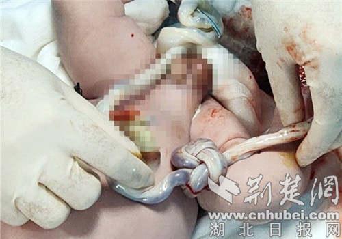 襄阳一男宝宝出生自带“中国结”