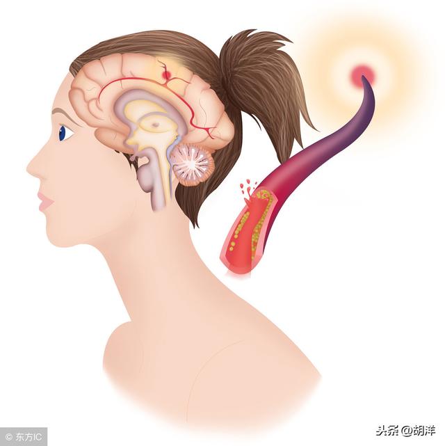 刘强东妹妹羊水栓塞去世，这个死亡率高达85%的疾病到底是什么病