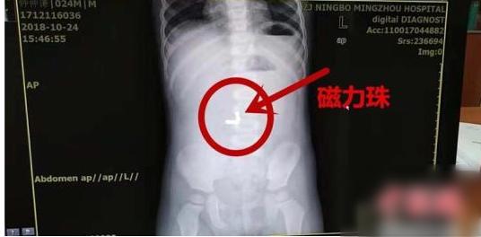 水晶泥磁力珠，热门玩具你研究过吗？已有孩子因此中毒胃穿孔！