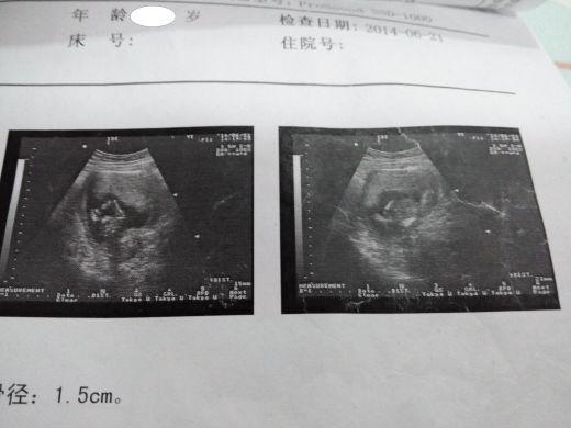 多低的hCG值定义为生化妊娠？孕妈一定要牢记这个数！