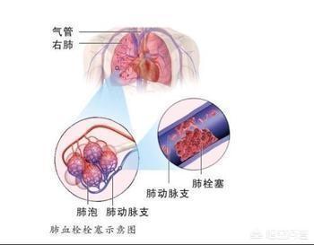 这种病是产妇的噩梦，死亡率高，救治成功率低