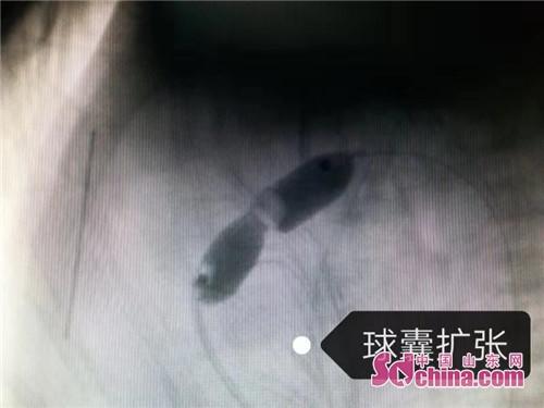 “在妈妈肚子里就做手术的”宝宝出生了！专家建议：这种先心病千万别轻易放弃治疗