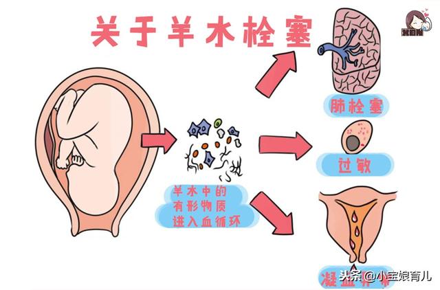 羊水栓塞到底有多可怕？医生：给孕妇4个忠告！