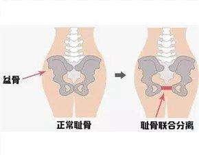 孕期耻骨疼到底有多疼？看完这些回答，真的心疼准妈妈