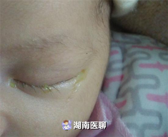 3个月宝宝成天眼泪汪汪？新生儿患泪囊炎，光点眼药水可治不了！