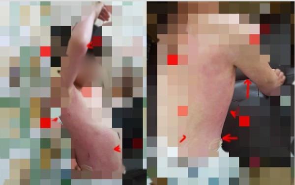 孩子被烫伤，幼儿园竟不闻不问！如何帮孩子选幼儿园