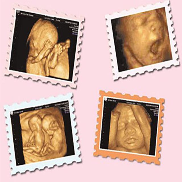 孕产说：去做四维彩超，宝宝不翻身，你们都是怎么处理的呢？