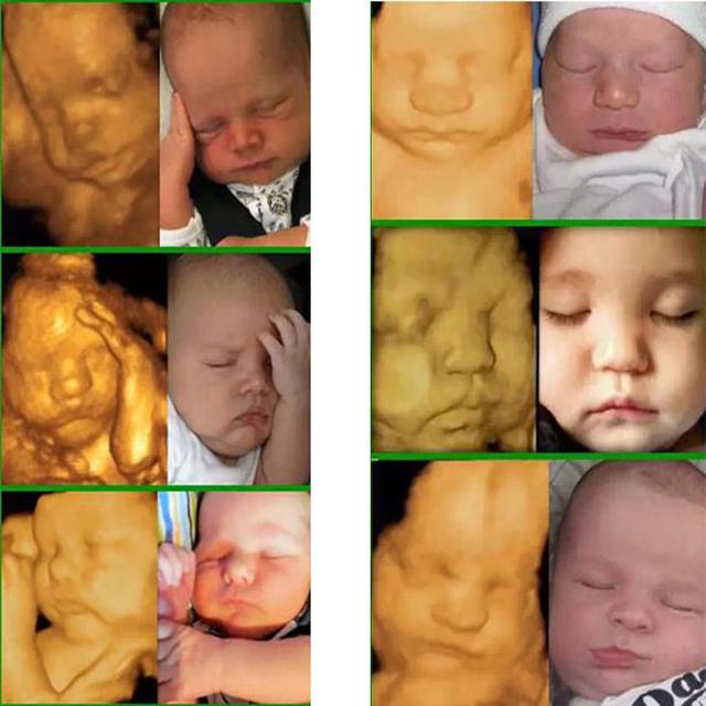 孕产说：去做四维彩超，宝宝不翻身，你们都是怎么处理的呢？