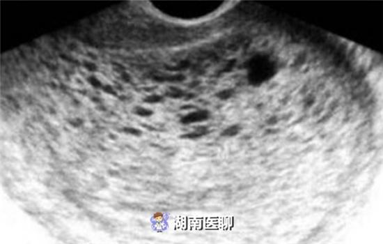 女子怀孕2月第一次检查，结果有点懵：怀了一肚子“葡萄”？