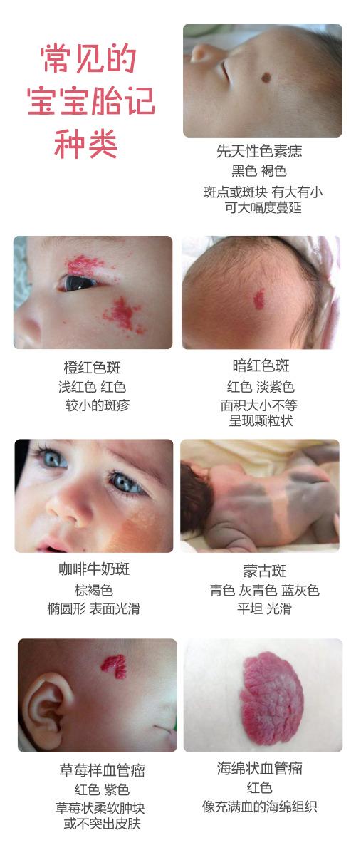 宝宝的胎记看命相？这些胎记是病！得治！