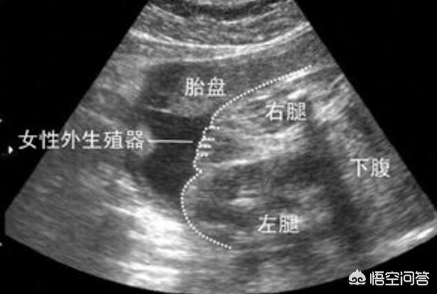 怀孕6个月去做B超，医生问头胎是啥，听说是闺女不说话了代表什么