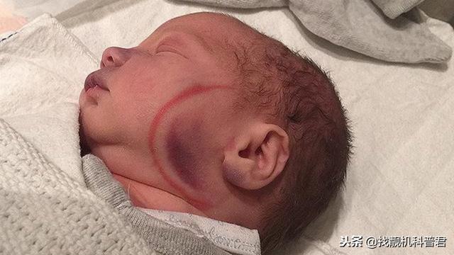 为什么有的孕妇生孩子，医生会用到产钳？