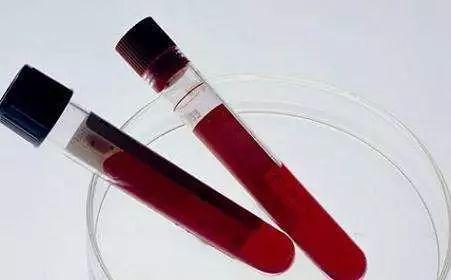 不是所有“O”型血都会新生儿溶血