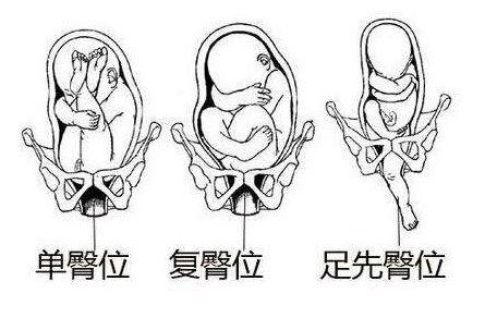 当B超单显示臀位，就一定要剖腹产吗？6周内调成头位，还可顺产