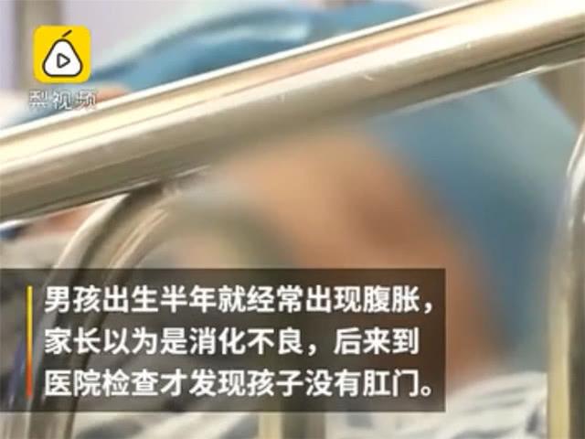 男婴天生没有肛门，一年后父母到医院检查才知晓，医生看了很惊讶