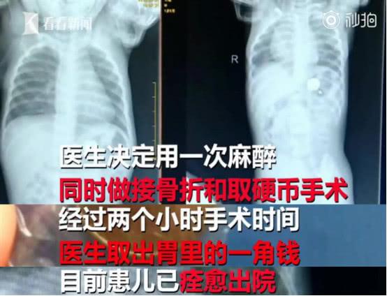 1岁男婴摔断胳膊入院后被发现“胃里有钱”，原因是孩子爱玩这些
