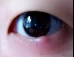 眼睛长麦粒肿，舌红，暗示上焦瘀滞有热，需留意积食