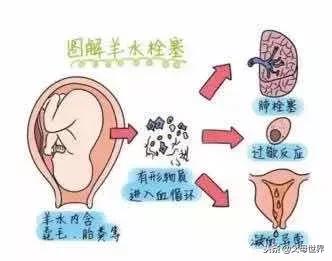真相:一次成功的羊水栓塞抢救,关键靠什么?