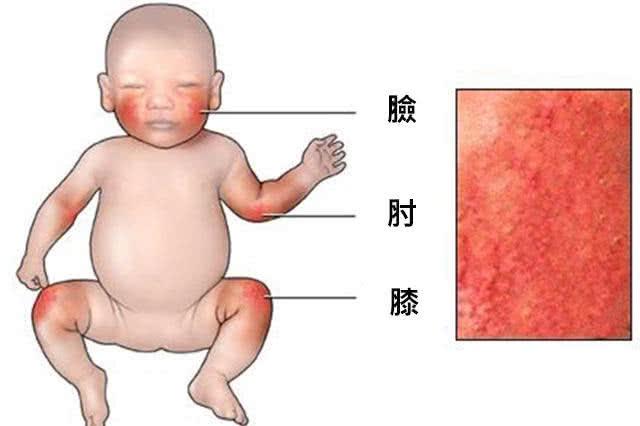 婴儿玫瑰疹，会传染吗？要不要替宝宝退烧？