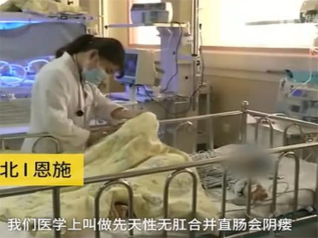 男婴天生没有肛门，一年后父母到医院检查才知晓，医生看了很惊讶