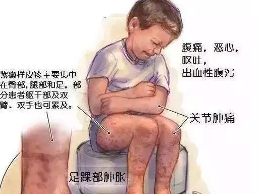 孩子总喊肚子疼，不料是过敏性紫癜！家长莫大意！