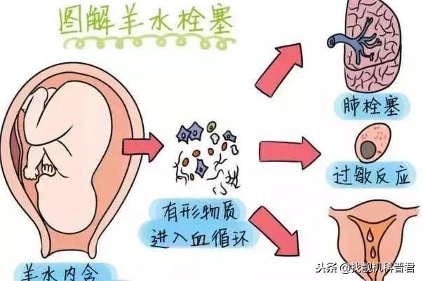 被称为产妇杀手的羊水栓塞，到底是什么？有多可怕？