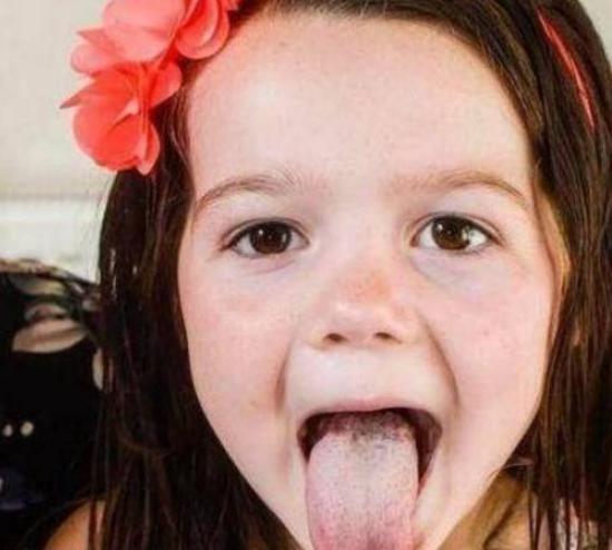 国外一4岁女童患怪病，身体两边都不对称