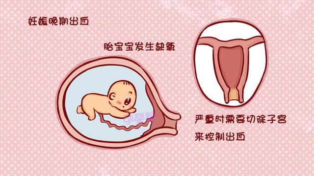 女子怀孕7次流产3次，检查后得知，原来是前置胎盘在“作梗”！