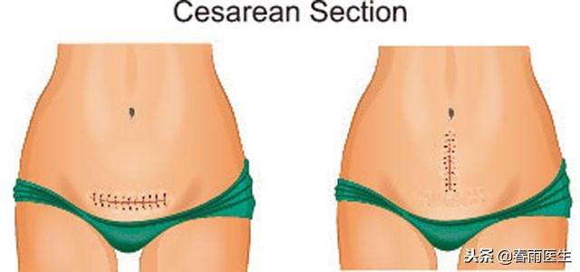 生完孩子，要不要赶紧把腹带绑起来？