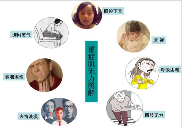 一位妈妈的粗心大意导致孩子得了重症肌无力