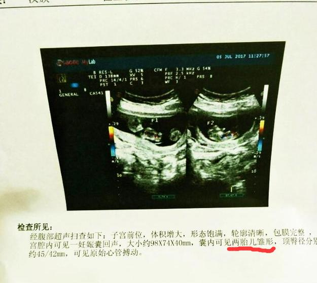单胎可以翻成双胎，双胎也可以翻成单胎？孕早期这些情况是信号