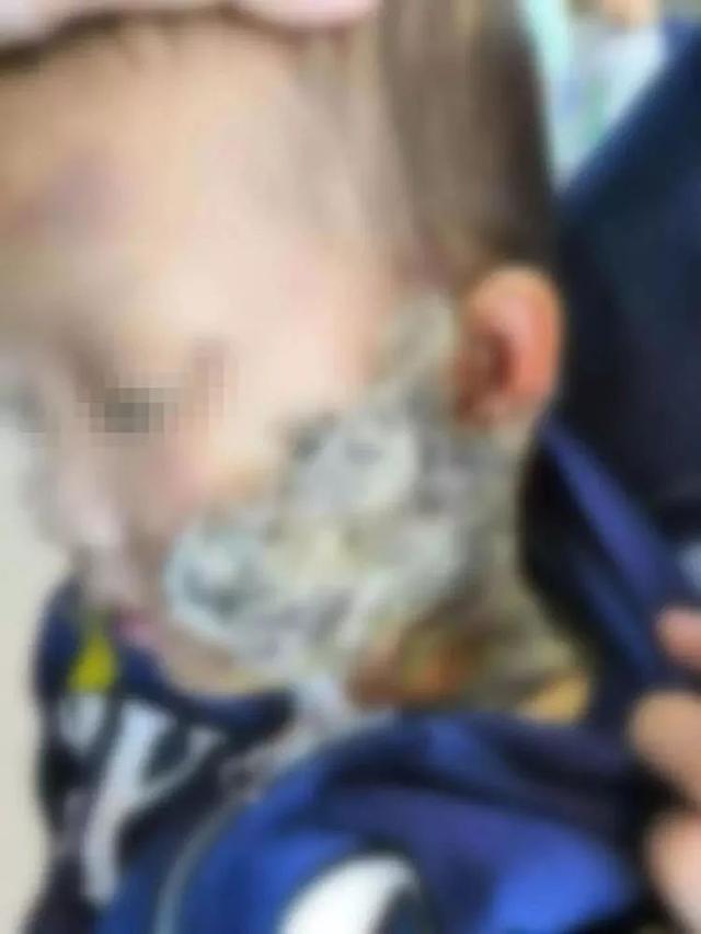 注意｜3岁宝宝小脸被烫伤，家人竟然用猫毛糊一脸