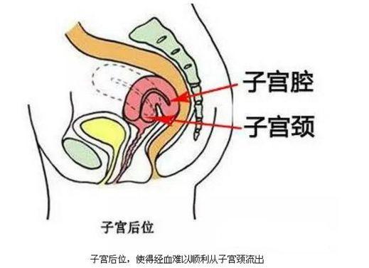 子宫后位会影响怀孕吗？关于宫后位你不知道的事……