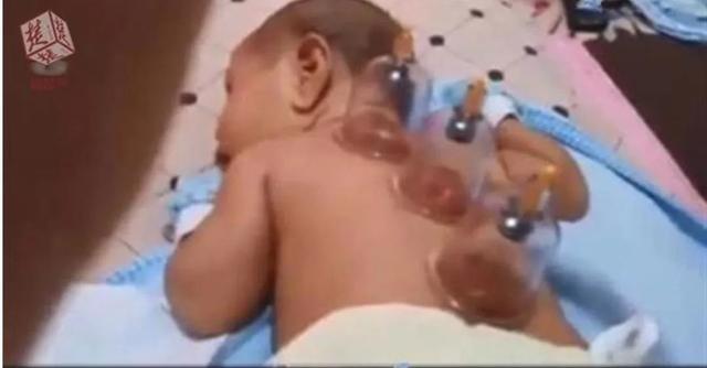 给宝宝拔罐？对宝宝的伤害远远大于它的功效啊！