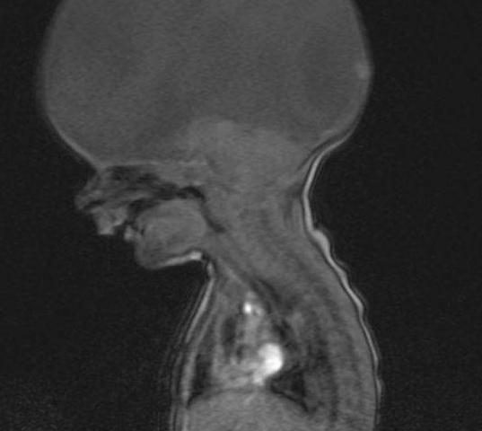 英国男婴出生没完整大脑，医生称活不了几天，如今2岁会喊妈妈！