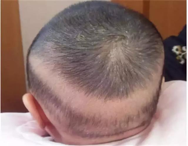 宝宝有枕秃是缺少了什么？枕秃如何护理？