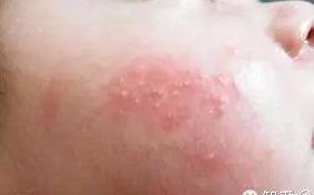 急疹、湿疹、风疹、水痘、幼儿各种疹子的症状及护理！妈妈收藏！