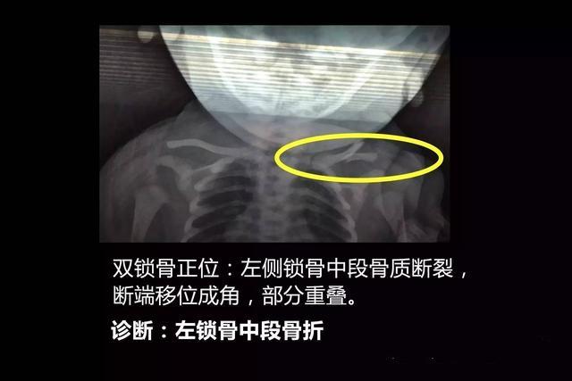 为啥有的顺产宝宝，出现了锁骨骨折？这种情况下不需要治疗