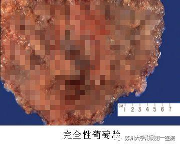 医生说我怀了个葡萄？葡萄胎！
