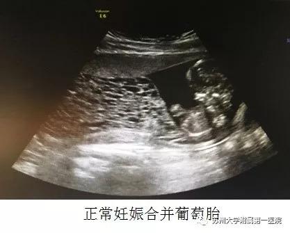医生说我怀了个葡萄？葡萄胎！