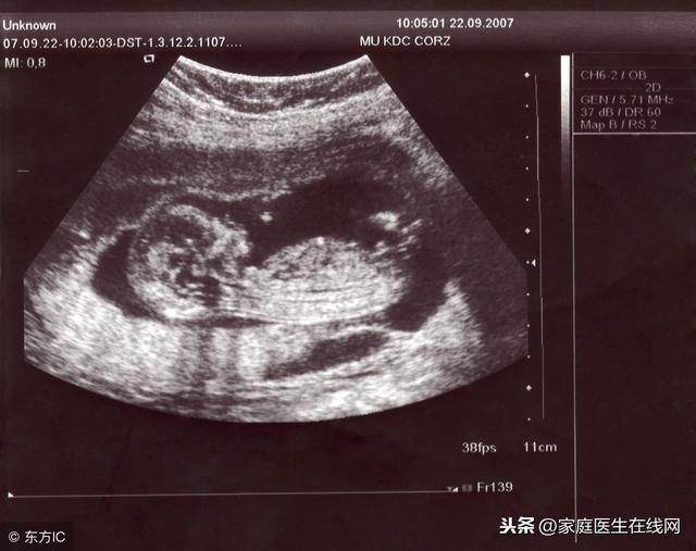 孕妇做四维彩超，提前做好4个“准备”，确保结果更准确