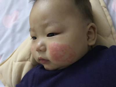 奶藓？湿疹？傻傻分不清楚，可把母乳喂养的宝妈给愁坏了