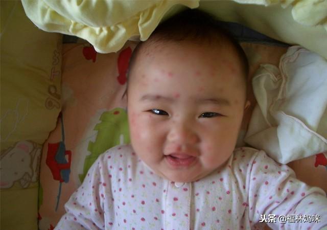 宝宝染上水痘，别只顾着着急！做好这4点，宝宝不“破相”