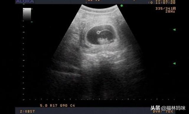 孕检发现孕酮低，胎儿还能保住吗？医生往往会给这样的建议