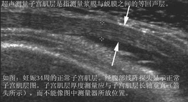 孕妇子宫疤痕很薄，医生建议39周剖腹产，子宫疤痕厚度影响分娩吗