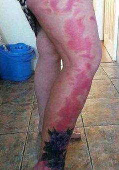 女孩出生就有大片胎记，为不让女儿自卑父母纹“同款”
