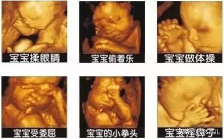 排畸检查宝宝手挡脸？做好这四项准备，四维顺利通过