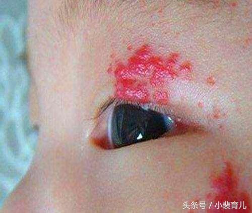 宝宝身上长的这几种痣，宝妈一定要引起重视