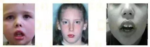 很多孩子的口呼吸，当你发现已经来不及了！