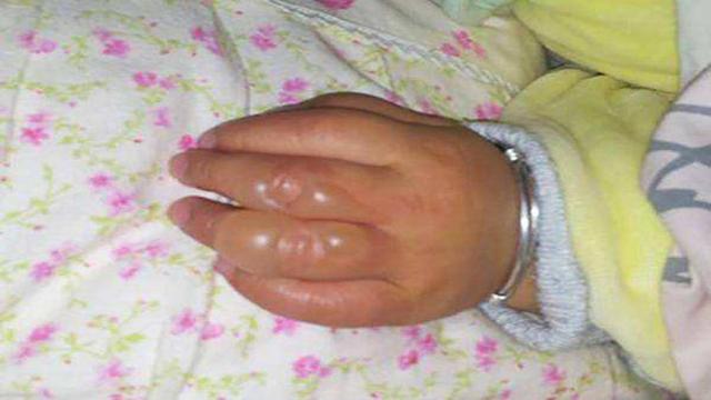 孩子被烫伤后，4做5不做可减轻孩子痛苦，收藏起来说不定哪天会用到